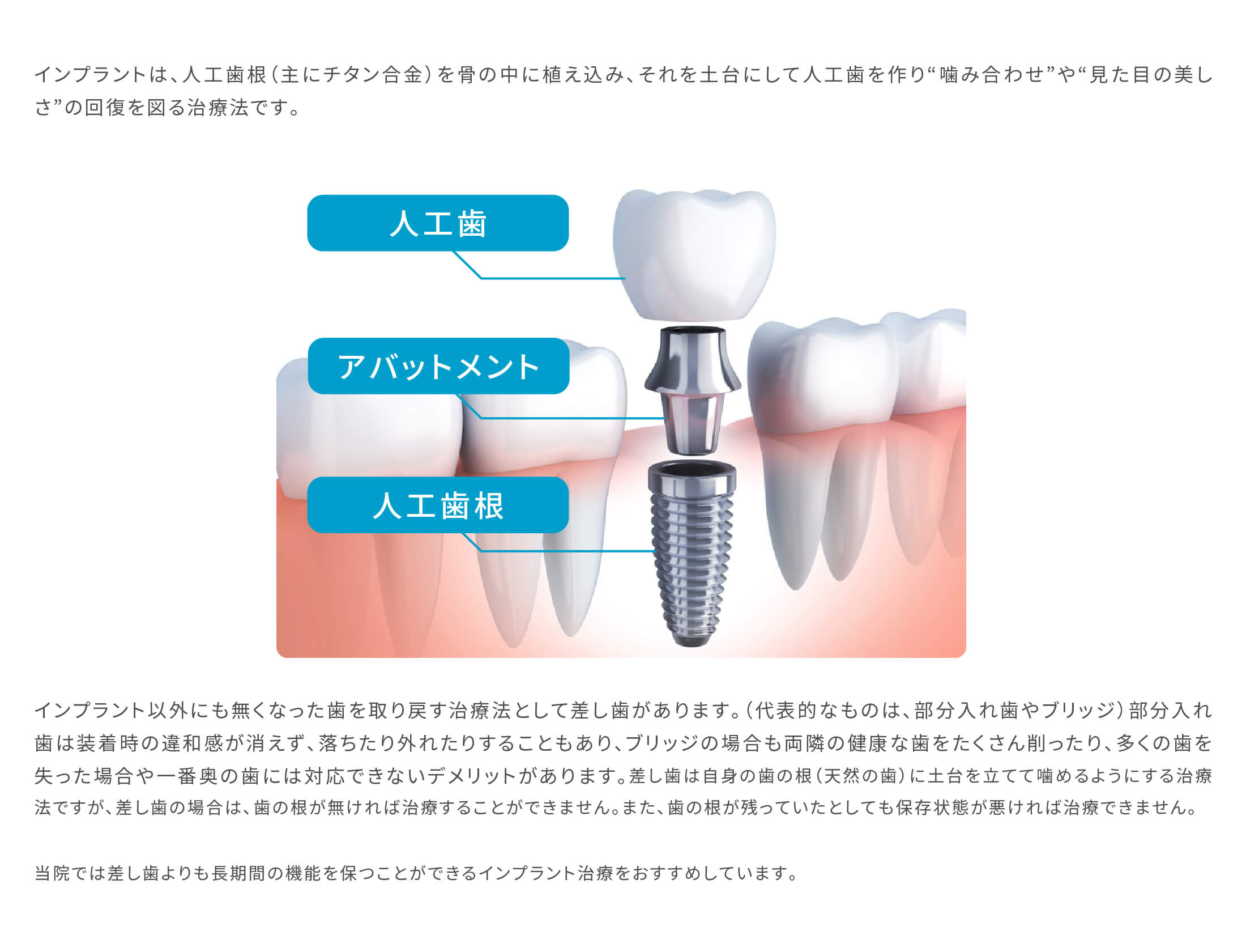インプラントは、人工歯根（主にチタン合金）を骨の中に植え込み、それを土台にして人工歯を作り“咬み合わせ”や“見た目の美しさ”の回復を図る治療法です。