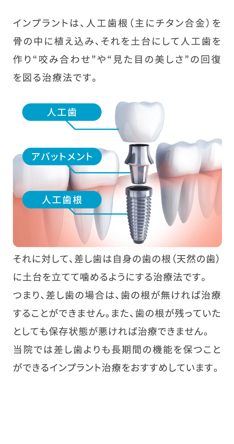 インプラントは、人工歯根（主にチタン合金）を骨の中に植え込み、それを土台にして人工歯を作り“咬み合わせ”や“見た目の美しさ”の回復を図る治療法です。